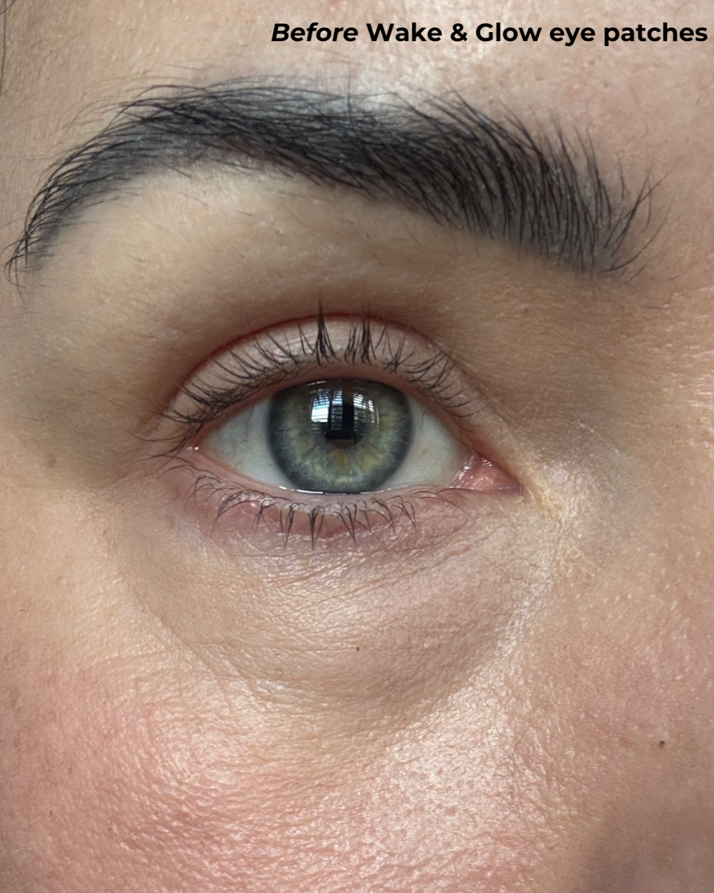 Before eye patches